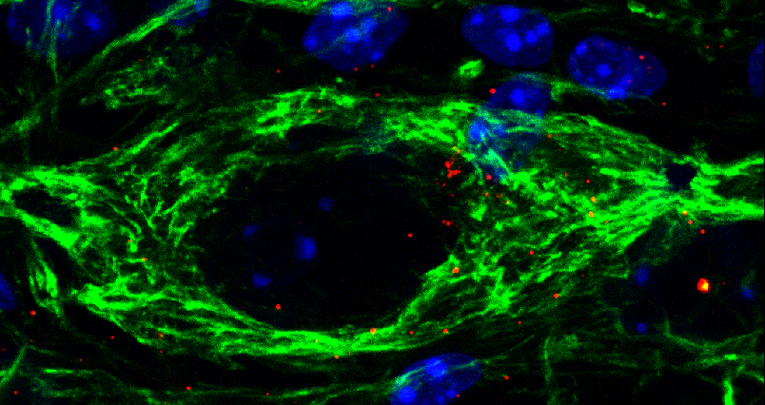 Modulare la "pulizia cellulare": una possibile cura per la SMA