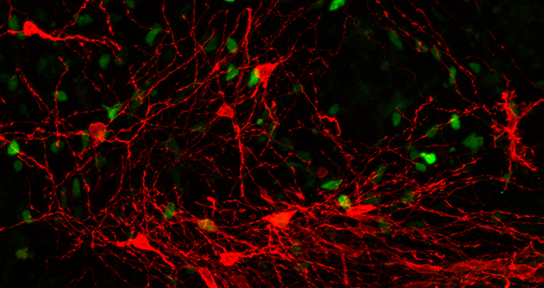 Malattia di Huntington: trapianto di neuroni umani prodotti in provetta 