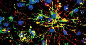 Sclerosi multipla: lesioni del tessuto cerebrale associate a un'alterazione della proteina A20